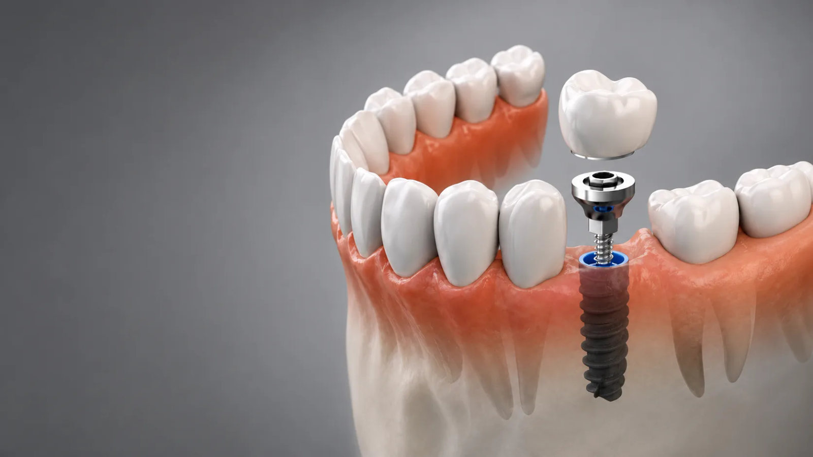 A clear aligner